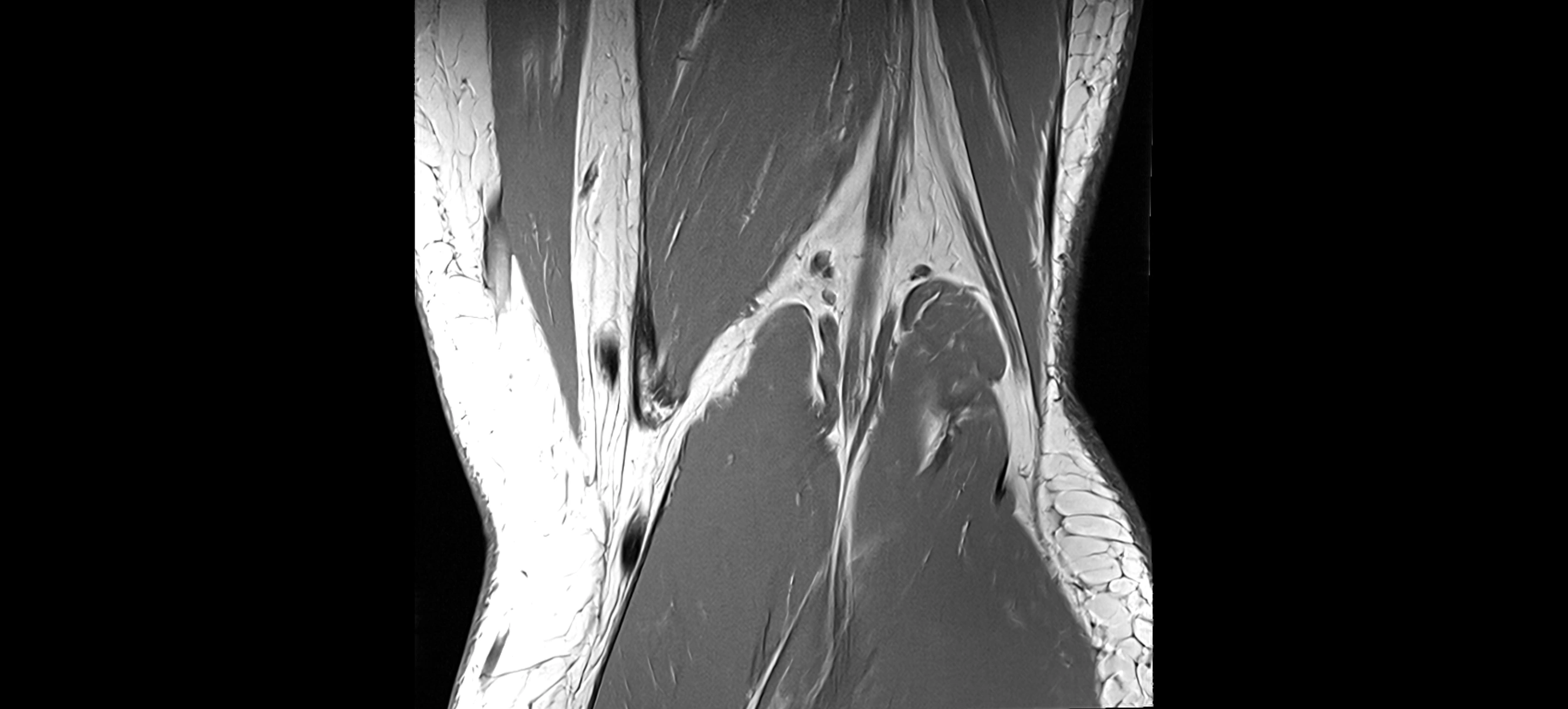MRI coronal  ligaments cross sectional anatomy 3T  radiology  image-img-04001-00036.webp